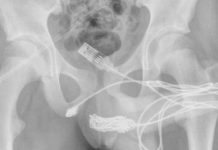 Un chico intentaba medir su pene y se le enredó un cable USB en la uretra: tuvieron que operarlo