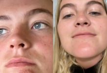 Una chica sufrió una grave infección tras besar a un hombre con barba